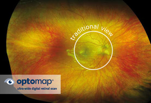 Optomap eye infographic